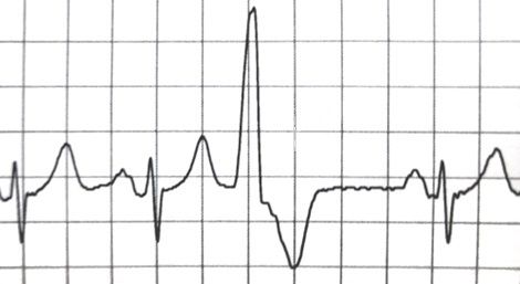 Prematuur ventriculair complex (PVC)   