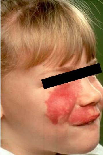 Meisje met een capillaire malformatie in het gezicht vóór de laserbehandeling.