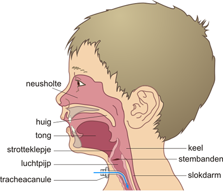 Schematische voorstelling positie trachea canule bij een kind 