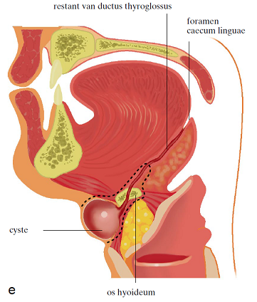 Figuur overgenomen uit Nederlands Tijdschrift voor Geneeskunde. U ziet de cyste met kanaal (ductus thyroglossus ) vanaf de tongbasis (foramen caecum linguae) door het tongbeen (os hyoideum) naar de schildklier.