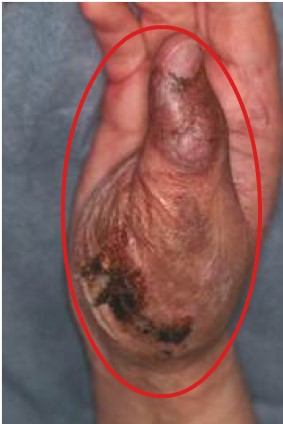 Een arterioveneuze malformatie van de hand.