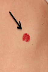 Een klein oppervlakkig hemangioom. Daarbij is er ook wat zwelling onder de roodheid te zien, waarbij het hemangioom in de diepte zit.