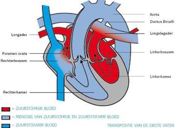 De bloedsomloop bij transpositie van de grote vaten bij een pasgeboren kind, met een open Ductus Botalli en open foramen ovale.