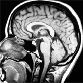 Een MRI-afbeelding van het hoofd