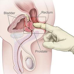 Onderzoek en diagnose bij anuskanker