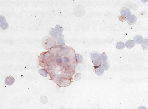 Niemann Pick disease type A/B