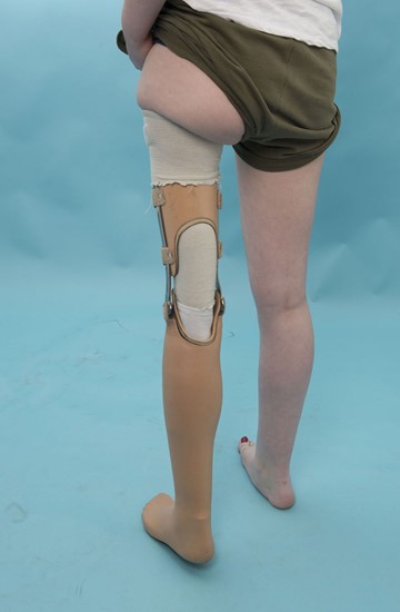 Figuur 10c - prothese bij omkeerplastiek