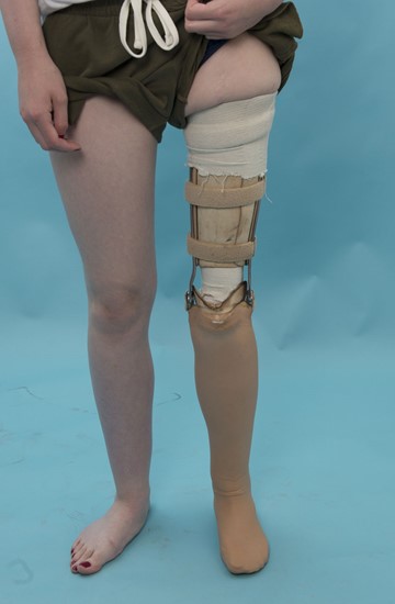 Figuur 10a - prothese bij omkeerplastiek