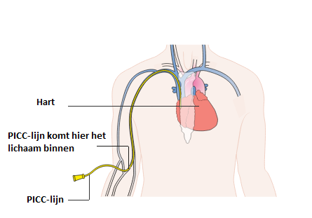 Schematische weergave PICC-lijn