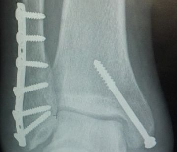 Geen stabilisatieschroeven