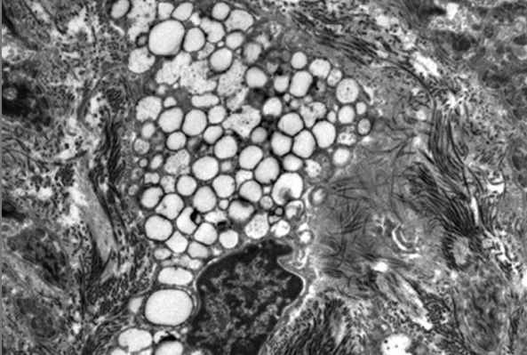 Mucopolysaccharidoses type I, III and IV