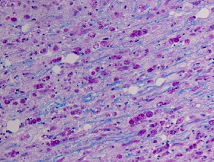 Metachromatic leukodystrophy